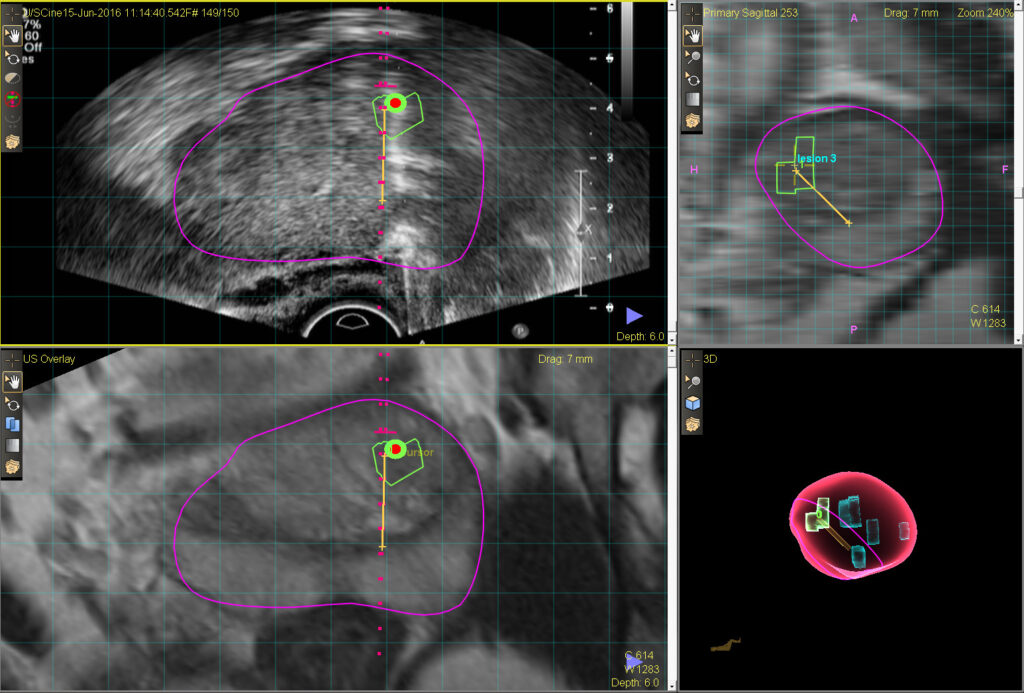 prostate cancer